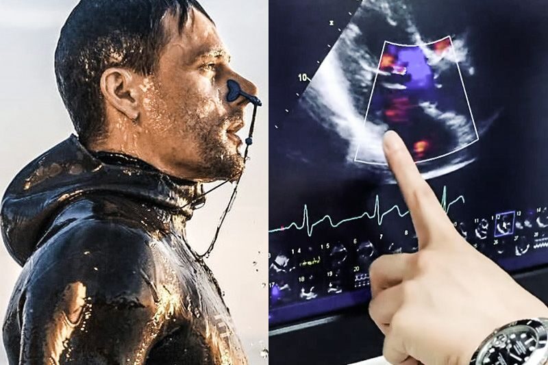 Florian Dagoury, world record holder for apnea, diagnosed with myocarditis and pericarditis after his Pfizer vaccination